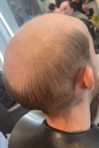 Bliss Mens Hair Replacement Services in Nottingham and Loughborough